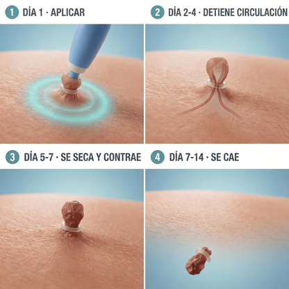 Kit para eliminar acrocordones sin dolor