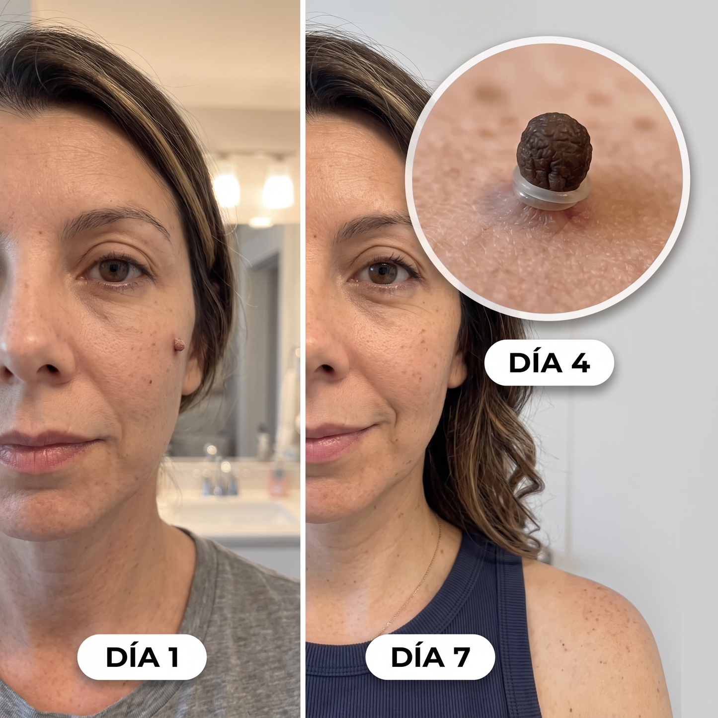 Kit para eliminar acrocordones sin dolor