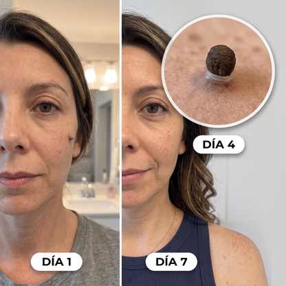 Kit para eliminar acrocordones sin dolor
